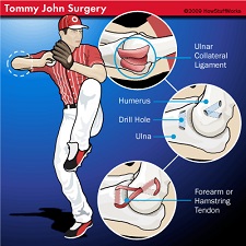 Tommy John Surgery 225 Tommy John Surgery 225